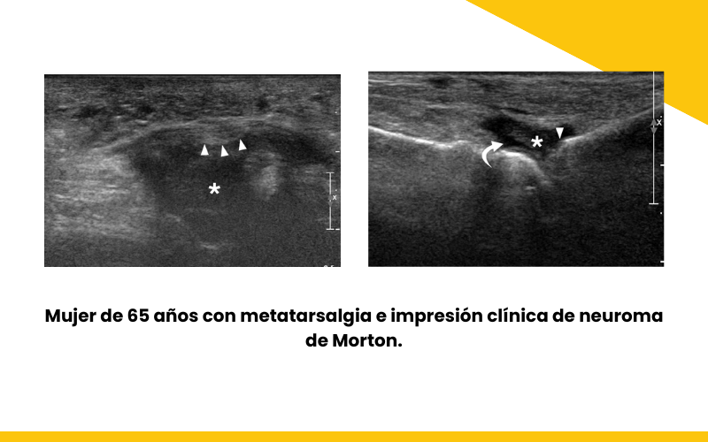 2. Bursitis intermetatarsiana y ecografia tempo formacion.png